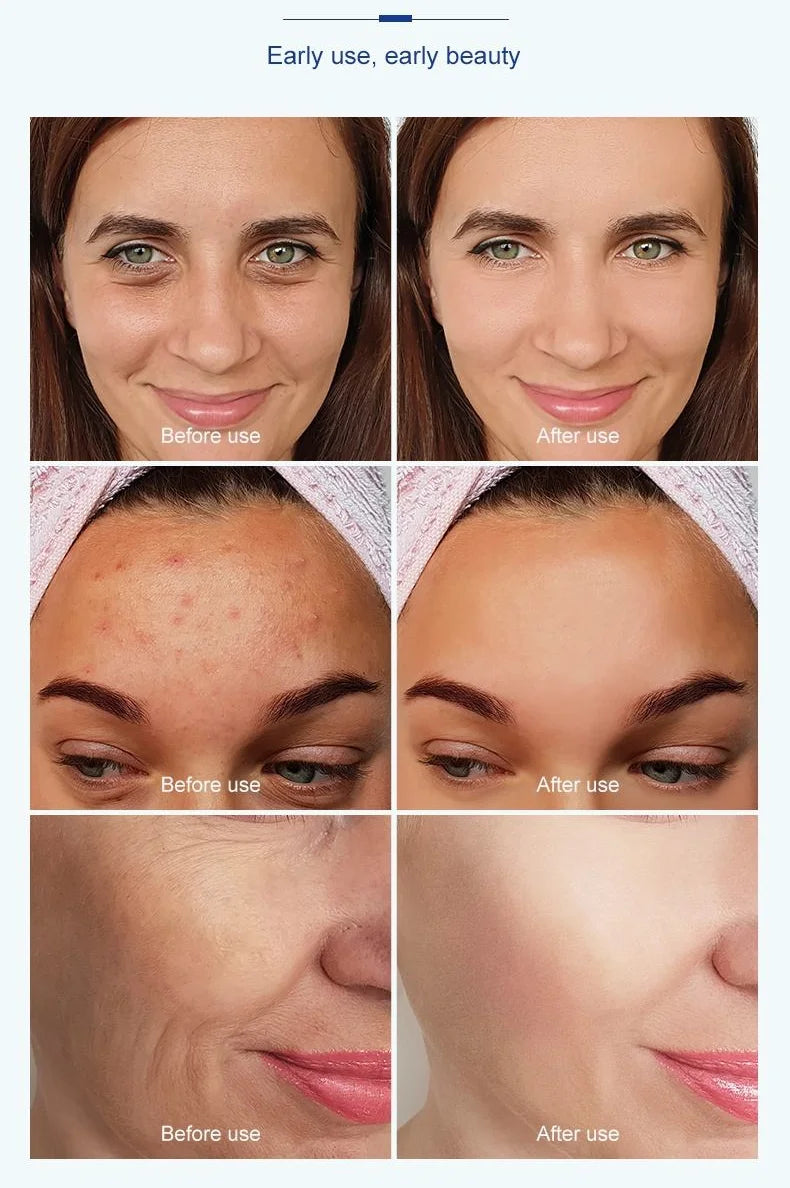 Top Rated 3in1 Nano Vacuum Injection Mesotherapy Gun RF EMS Technology For Face Lifting Whitening Wrinkle Remove Machine